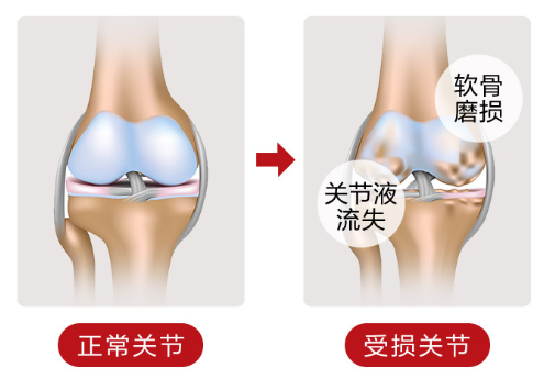 关节疼痛吃氨糖软骨素有效果吗？-第1张图片-破壁灵芝孢子粉研究指南