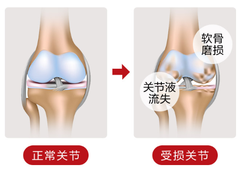 很多人不知道氨糖维骨力的功效！-第1张图片-破壁灵芝孢子粉研究指南