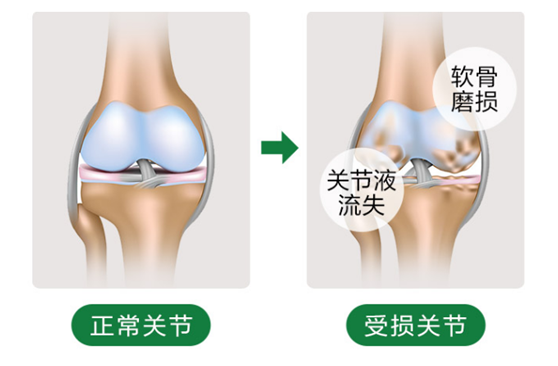 血糖高能吃氨糖软骨素钙片吗？-第1张图片-破壁灵芝孢子粉研究指南