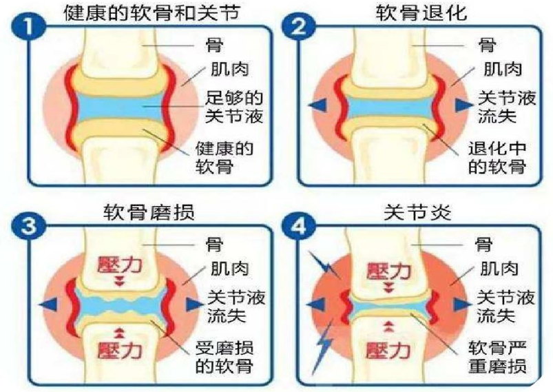 氨糖软骨素对关节炎有用吗?现在知道也不晚-第1张图片-破壁灵芝孢子粉研究指南