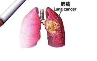 早期肺癌可以吃灵芝粉孢子吗？