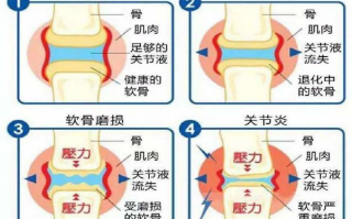 氨糖软骨素对关节炎有用吗?现在知道也不晚