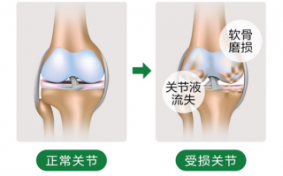 血糖高能吃氨糖软骨素钙片吗？