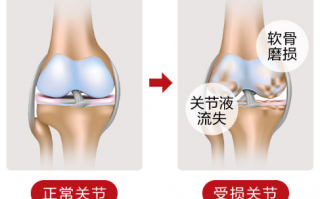 很多人不知道氨糖维骨力的功效！