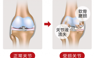 关节疼痛吃氨糖软骨素有效果吗？