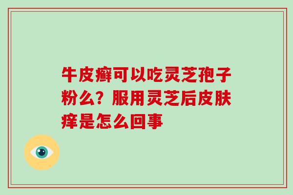牛皮癣可以吃灵芝孢子粉么?服用灵芝后皮肤痒是怎么回事-第1张图片-破壁灵芝孢子粉研究指南 牛皮癣可以吃灵芝孢子粉么?服用灵芝后皮肤痒是怎么回事-第1张图片-破壁灵芝孢子粉研究指南